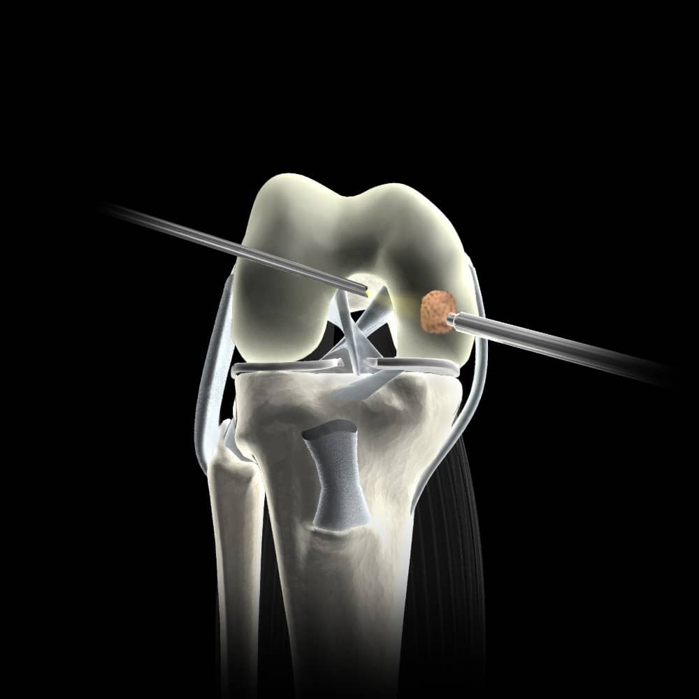 Articular Cartilage Repair Options For Arthritic Knees   Art Cartilage 3d Art (1) 